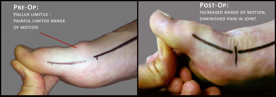 Hallux limitus correction showing increased range of motion after surgery