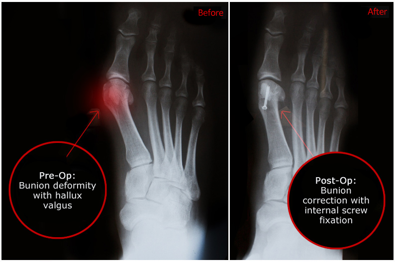 Featured bunion correction case with before and after X-rays