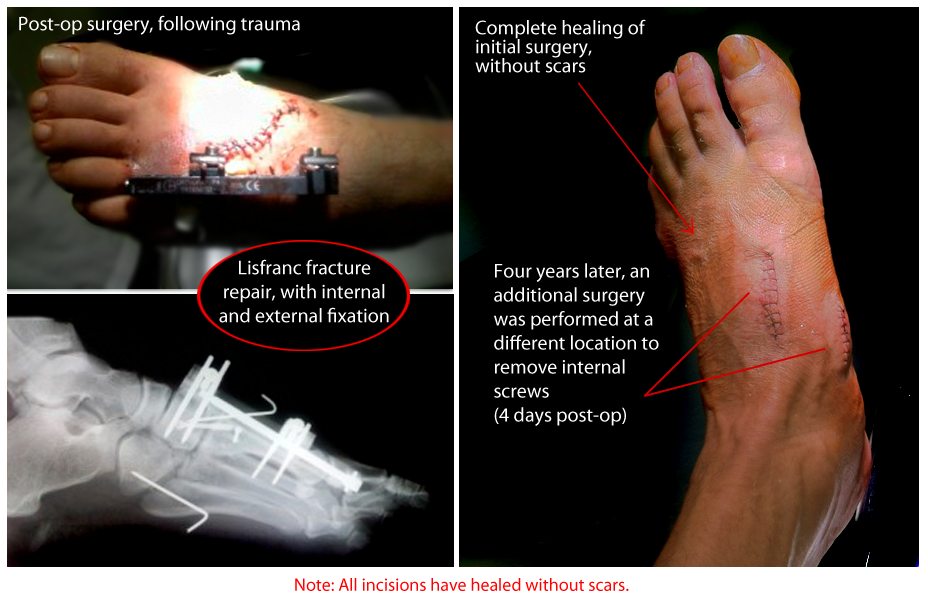 Lisfranc fracture repair case showing surgical recovery